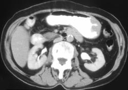 Gastric Adenocarcinoma - CTisus CT Scan