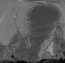 Gastric Adenocarcinoma - CTisus CT Scan