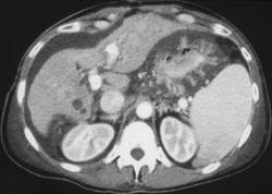 Gastritis - CTisus CT Scan