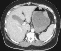 Lymphoma Involving Stomach and Small Bowel - CTisus CT Scan