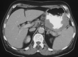 Gastric Cancer - CTisus CT Scan