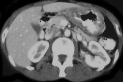 Gastric Cancer - CTisus CT Scan