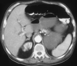 Gastric Pseudotumor - CTisus CT Scan