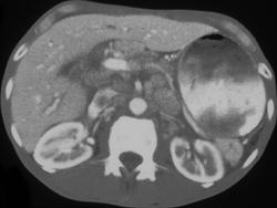 Gastric Cancer (antrum) With Adenopathy - CTisus CT Scan