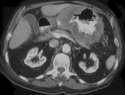 Gastric Cancer - CTisus CT Scan