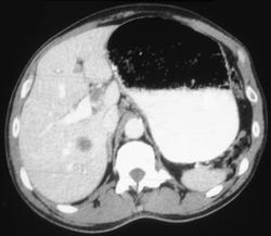 Gastric Cancer Causing Gastric Outlet Obstruction - CTisus CT Scan