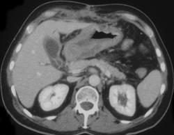 Gastric Cancer - CTisus CT Scan