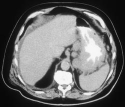 Gastric Lymphoma - CTisus CT Scan