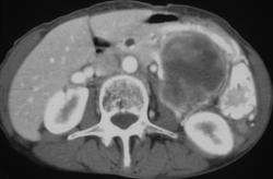 Gastric Leiomyosarcoma - CTisus CT Scan