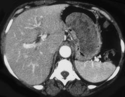 Gastric Leiomyosarcoma - CTisus CT Scan