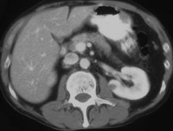 Gastric Cancer (polypoid) - CTisus CT Scan