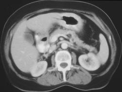 Gastric Cancer (infiltrating) - CTisus CT Scan