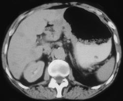 Krukenberg Tumor Due to Gastric Cancer - CTisus CT Scan