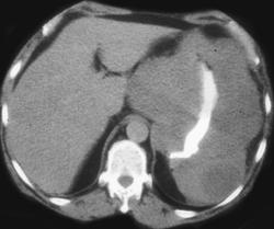 Gastric Lymphoma - CTisus CT Scan