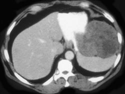 Gastric Leiomyosarcoma - CTisus CT Scan