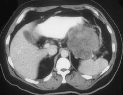 Gastric Leiomyosarcoma - CTisus CT Scan