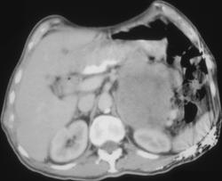 Gastric Leiomyosarcoma With Bone Mets - CTisus CT Scan