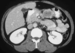 Gastric Leiomyoma - CTisus CT Scan