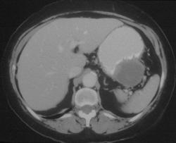 Implants on Stomach From Ovarian Cancer - CTisus CT Scan