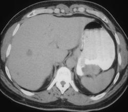 Gastric Leiomyoma - CTisus CT Scan