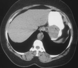 Ulcerating Gastric Leiomyoma - CTisus CT Scan