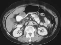 Gastric Leiomyoma - CTisus CT Scan