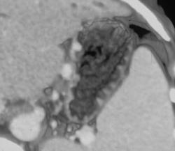 Gastric Varices - CTisus CT Scan