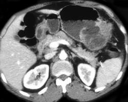 Gastrocolic Fistulae Secondary to Colon Cancer - CTisus CT Scan