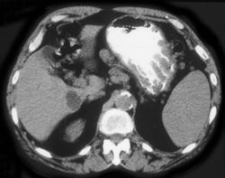 Gastric Lymphoma - CTisus CT Scan