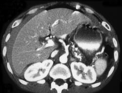 Perforated Gastric Ulcer (antrum) With Contrast Extravasation - CTisus CT Scan