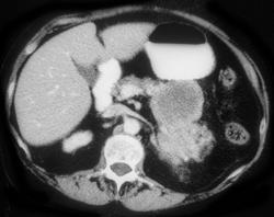 Gastric Leiomyosarcoma - CTisus CT Scan