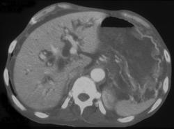 Normal Gastric Fold Enhancement. (note Ascites and Dilated Intrahepatic Ducts) - CTisus CT Scan