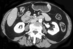 H. Pylori - CTisus CT Scan