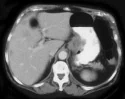 Ulcerating Adenocarcinoma of the Stomach With Liver Matastases - CTisus CT Scan