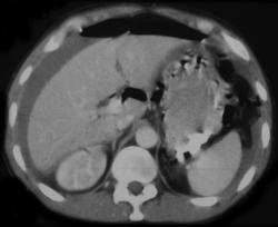 Pneumoperitoneum Due to Perforated Gastric Ulcer - CTisus CT Scan