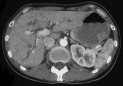 Subtle Gastric Cancer With Nodes in the Porta - CTisus CT Scan