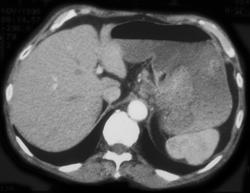 Subtle Gastric Cancer Nearly Missed By Food in the Stomach - CTisus CT Scan