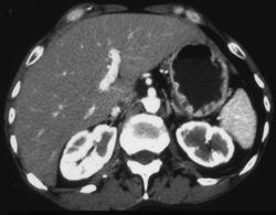 Normal Stomach - CTisus CT Scan