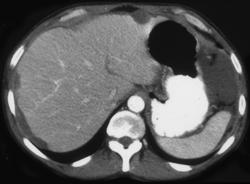 Pseudomyxoma Peritonei (PMP) - CTisus CT Scan