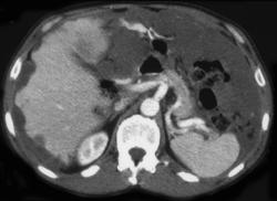 Pseudomyxoma Peritonei (PMP) - CTisus CT Scan