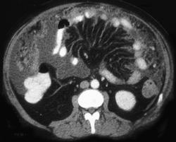 Carcinomatosis Due to Gastric Adenocarcinoma - CTisus CT Scan