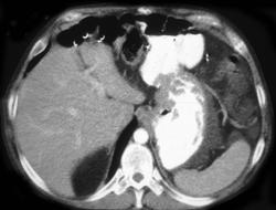 Recurrent Tumor at Gastrojejunostomy Site - CTisus CT Scan