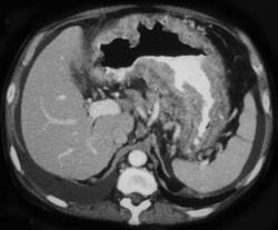 Kaposis Sarcoma of the Stomach - CTisus CT Scan