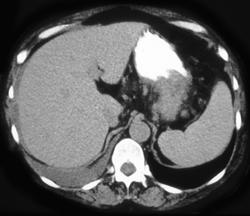 Gastric Adenocarcinoma With Tumor Spread - CTisus CT Scan