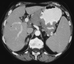 Gastric Lymphoma - CTisus CT Scan