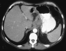 Gastric Adenocarcinoma With Extensive Nodes - CTisus CT Scan