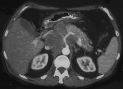 Gastric Carcinoma With Celiac Nodes - CTisus CT Scan