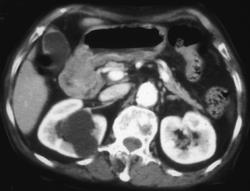 Carcinoma in the Gastric Antrum - CTisus CT Scan