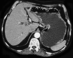 Gastritis With Subtle Gastric Wall Thickening - CTisus CT Scan