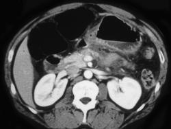 Antral Carcinoma - CTisus CT Scan